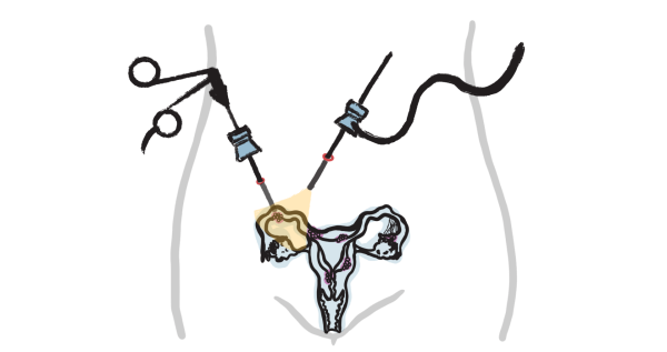 Endo_Diagnose_Laparoskopie